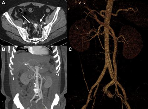 imaavm|Spontaneous inferior mesenteric arteriovenous fistula as a cause .